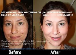 Permanent Skin Lightening Skin Whitening Products in Stockholm +27738432716 - photo