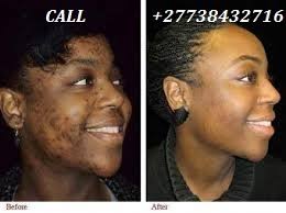 Permanent Skin Lightening Skin Whitening Products in Stockholm +27738432716 - photo